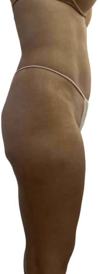 After treatment, side view of the abdomen and thigh