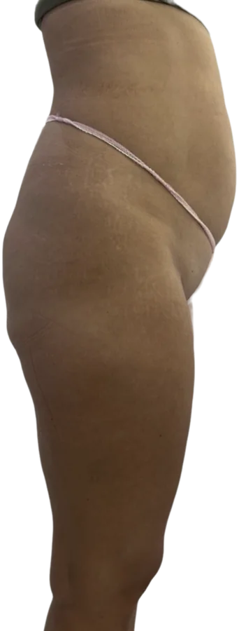 Before treatment, side view of the abdomen and thigh
