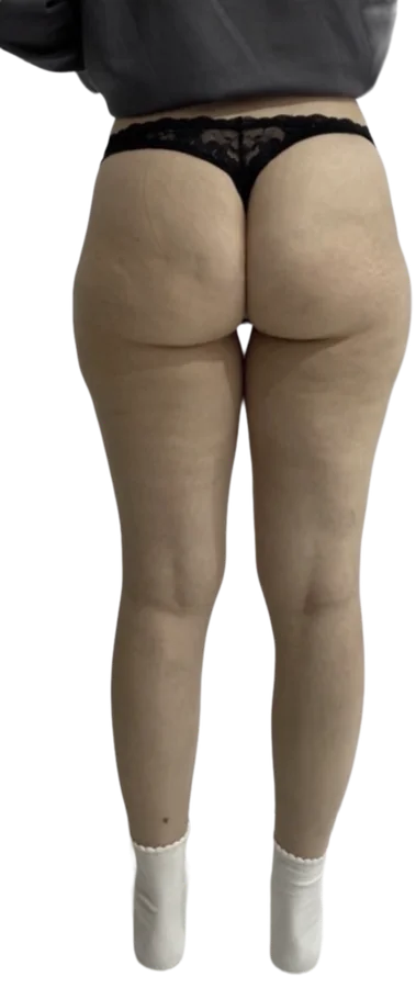 After treatment, back view of the thighs