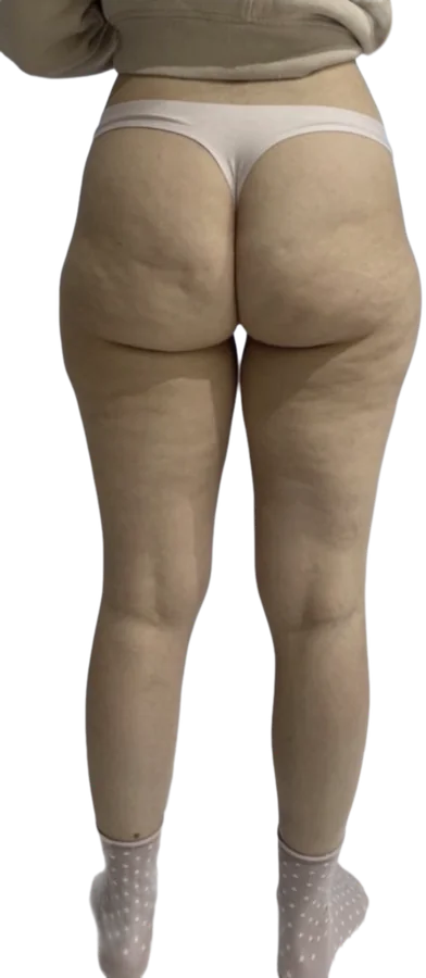Before treatment, back view of the thighs