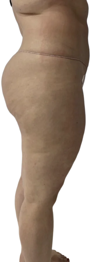 After treatment, side view of the abdomen and thigh
