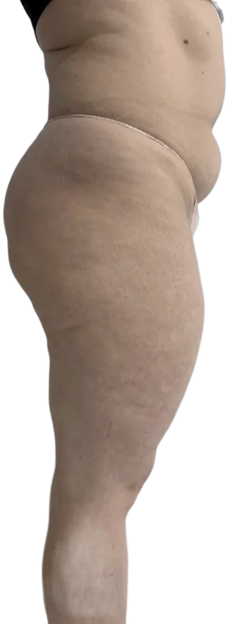 Before treatment, side view of the abdomen and thigh