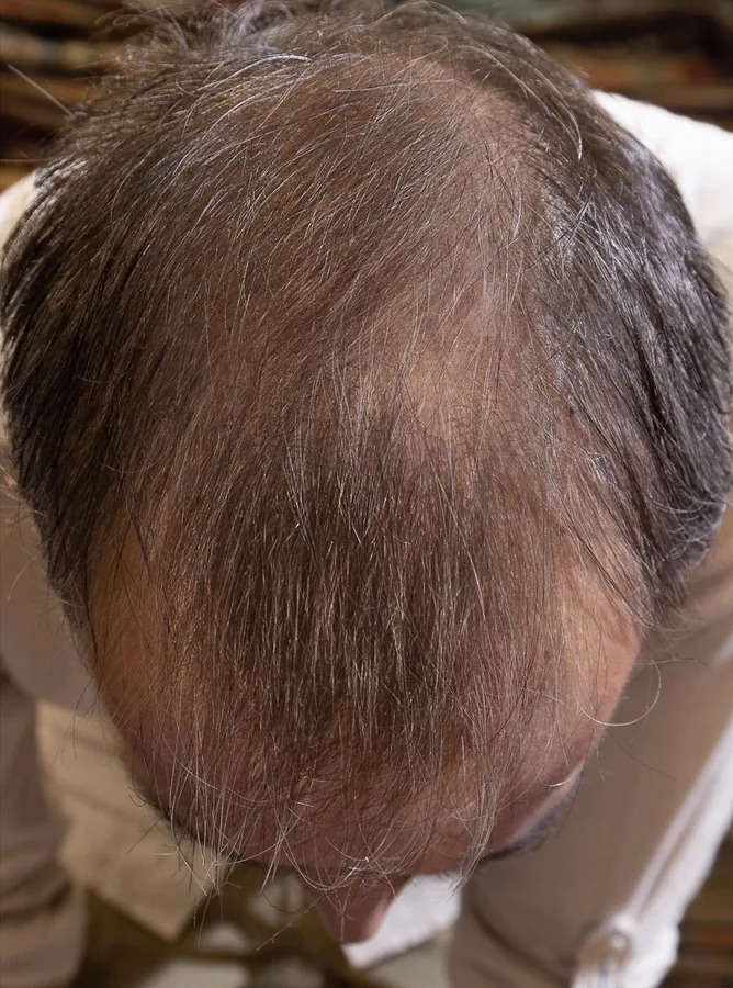 After treatment, top of the scalp