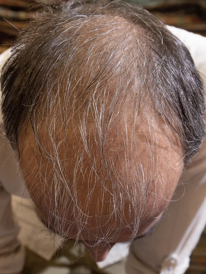 Before treatment, top of the scalp
