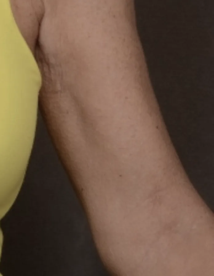 After treatment, upper arm