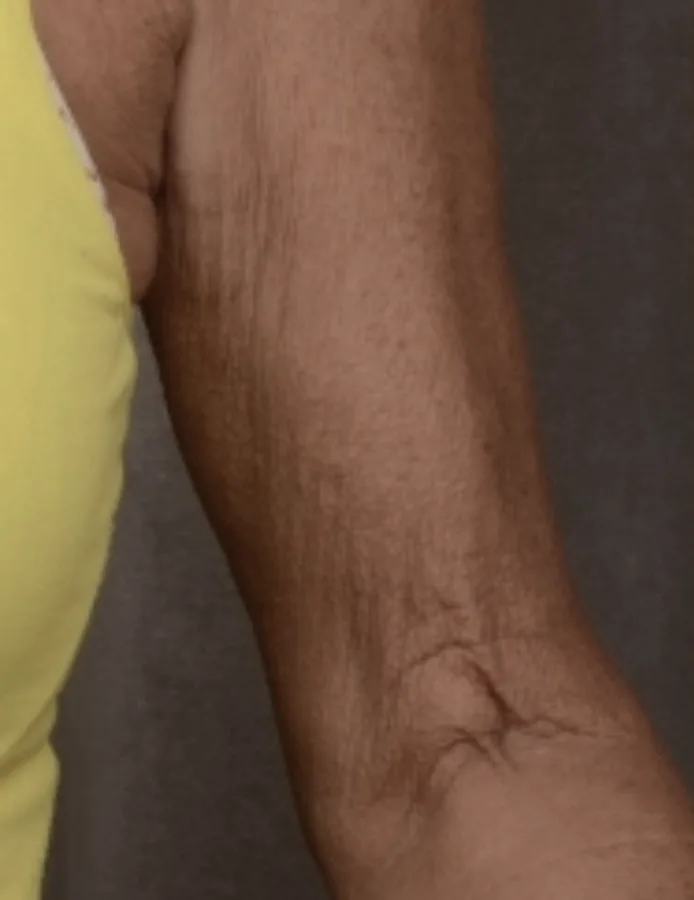 Before treatment, upper arm