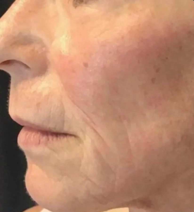 After treatment, side view of the lower face