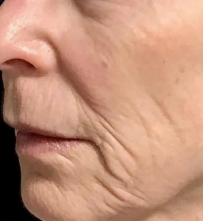Before treatment, side view of the lower face