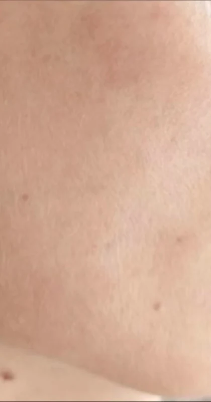 After treatment, cheek