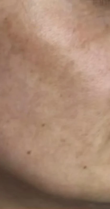 Before treatment, cheek