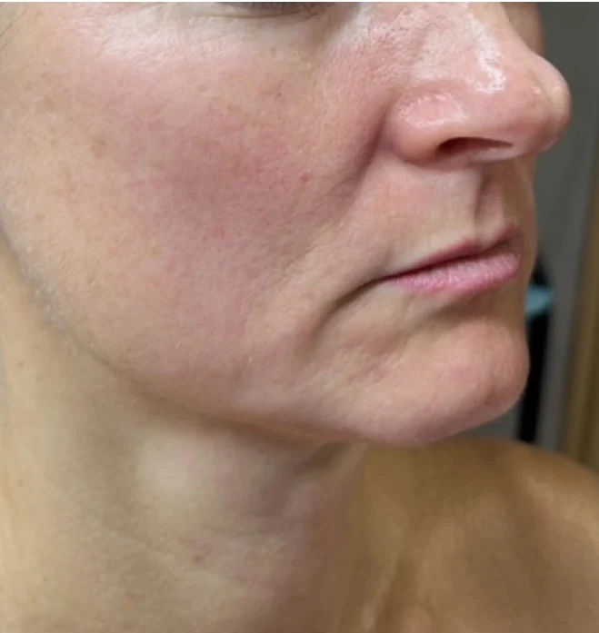 After treatment, lower face and jawline