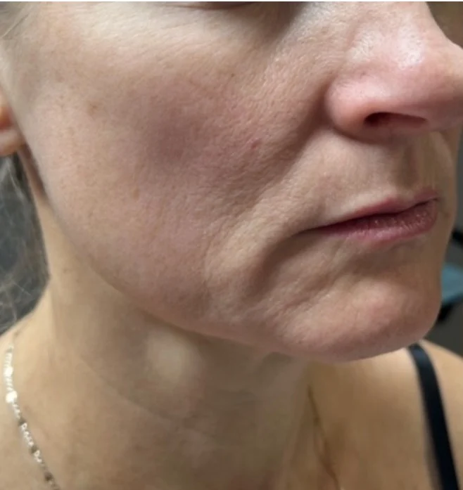 Before treatment, lower face and jawline