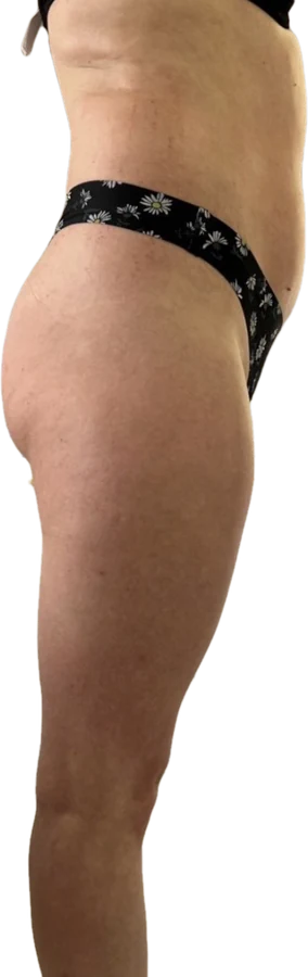 After treatment, side view of the abdomen and thighs