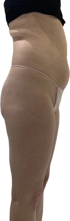 Before treatment, side view of the abdomen and thighs